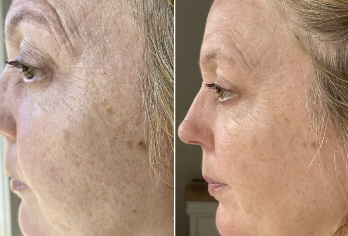 Before and after — Pigmentation & texture